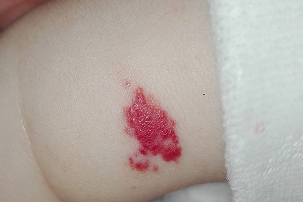 単純性血管腫(毛細血管奇形)